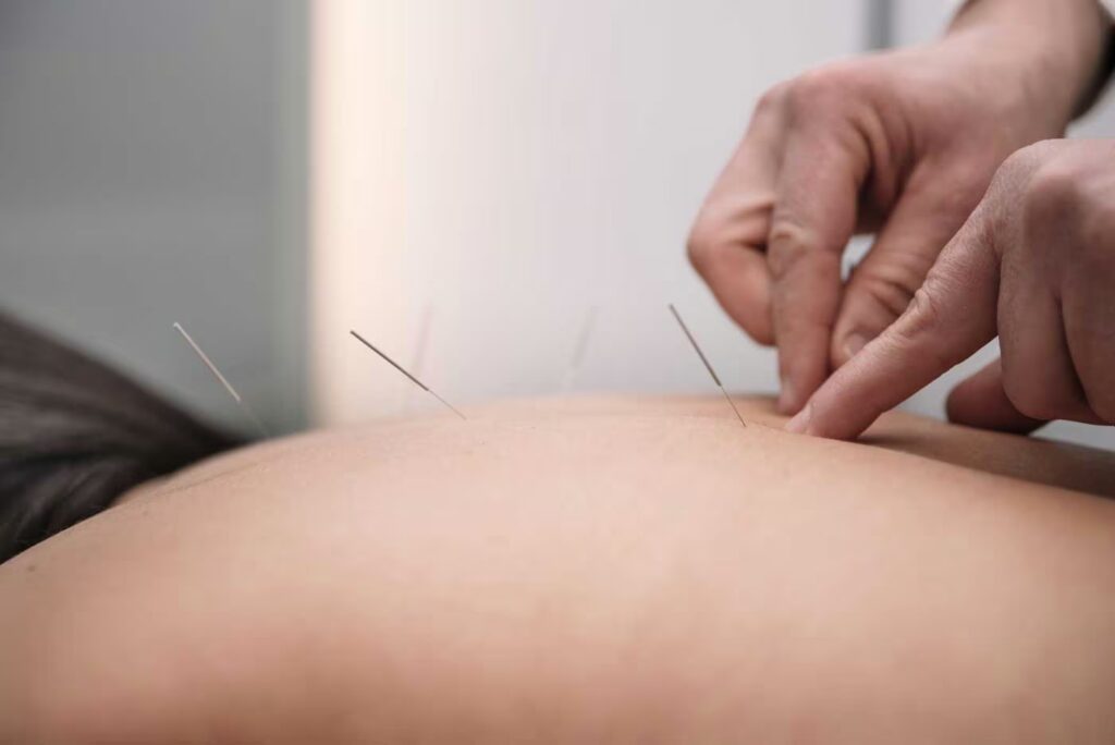 acupuncture needles treatment on patient 2025 03 13 01 23 41 utc