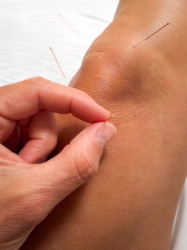dry needling