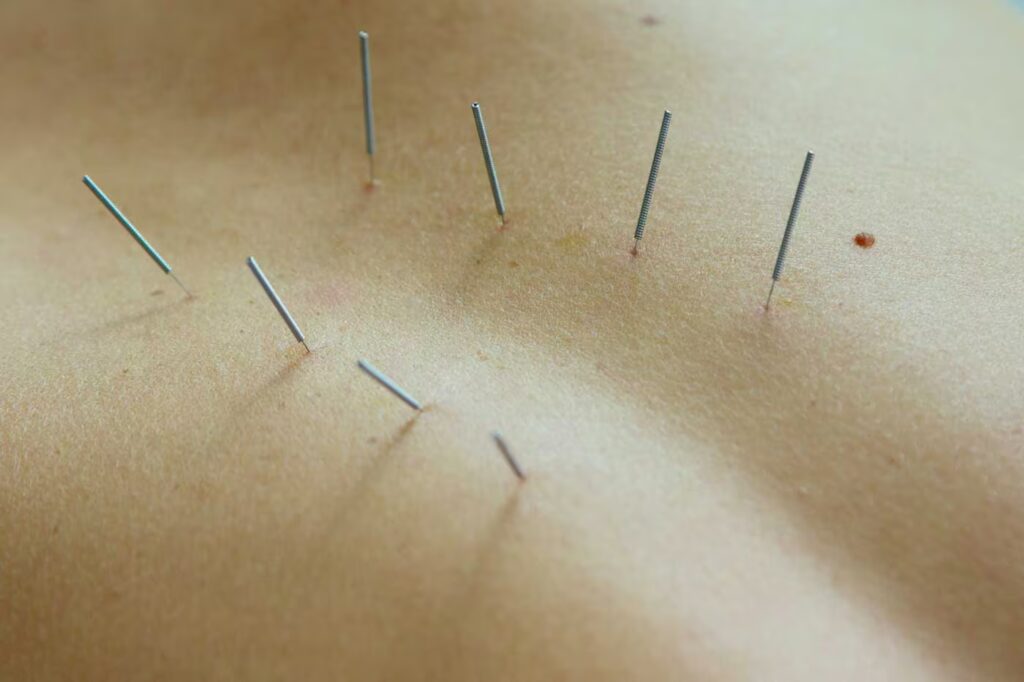 female back with steel needles during procedure of 2024 10 18 05 22 57 utc